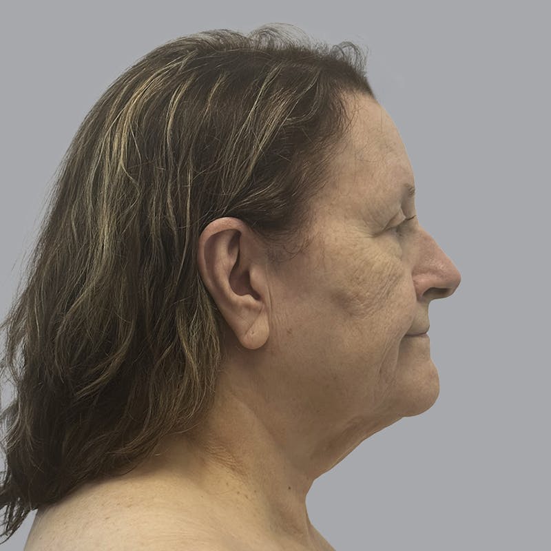 Facelift and Neck Lift Before & After Gallery - Patient 347471 - Image 5