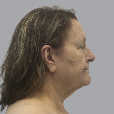Facelift and Neck Lift Before & After Gallery - Patient 347471 - Image 5