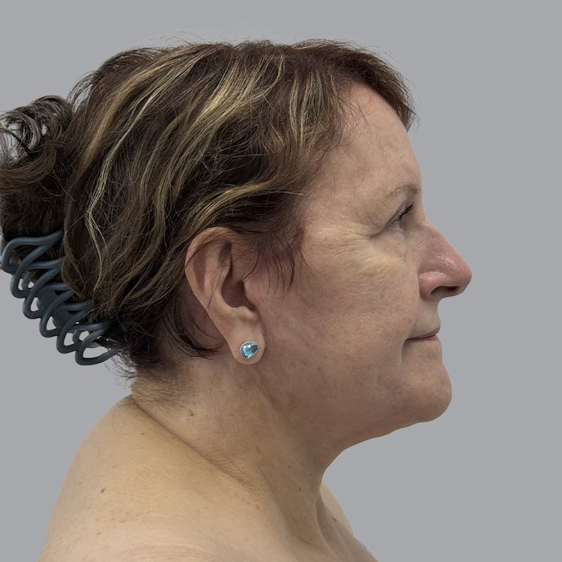 Facelift and Neck Lift Before & After Gallery - Patient 347471 - Image 6