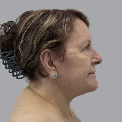 Facelift and Neck Lift Before & After Gallery - Patient 347471 - Image 6