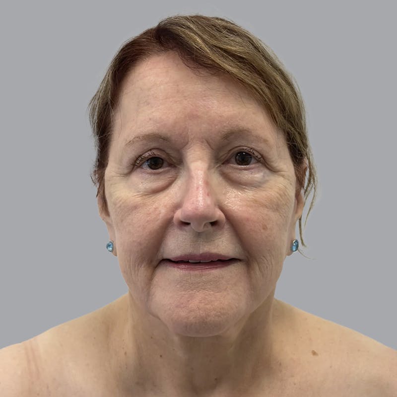 Facelift and Neck Lift Before & After Gallery - Patient 347471 - Image 2