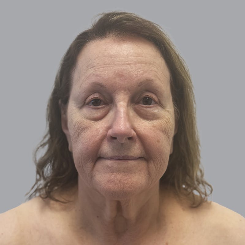 Facelift and Neck Lift Before & After Gallery - Patient 347471 - Image 1