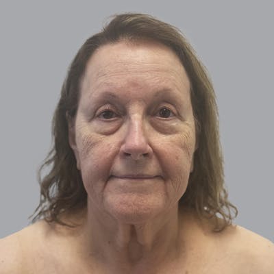 Facelift and Neck Lift Before & After Gallery - Patient 347471 - Image 1
