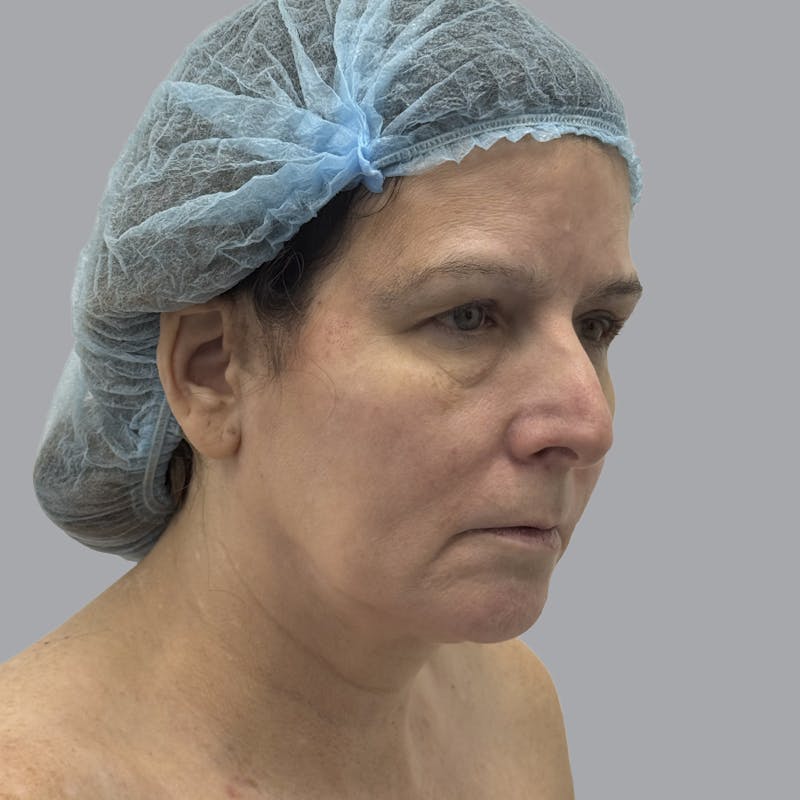 Facelift and Neck Lift Before & After Gallery - Patient 151612 - Image 5