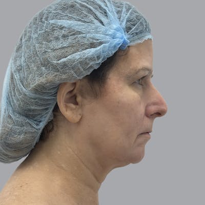 Facelift and Neck Lift Before & After Gallery - Patient 151612 - Image 3