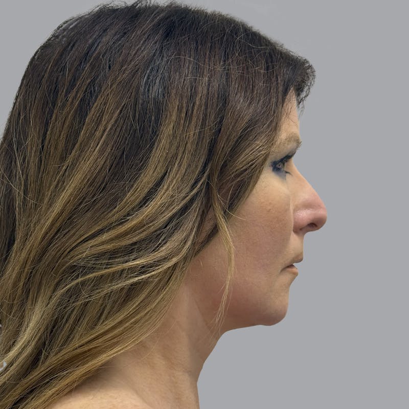 Facelift and Neck Lift Before & After Gallery - Patient 151612 - Image 4
