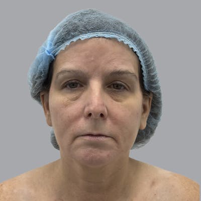 Facelift and Neck Lift Before & After Gallery - Patient 151612 - Image 1