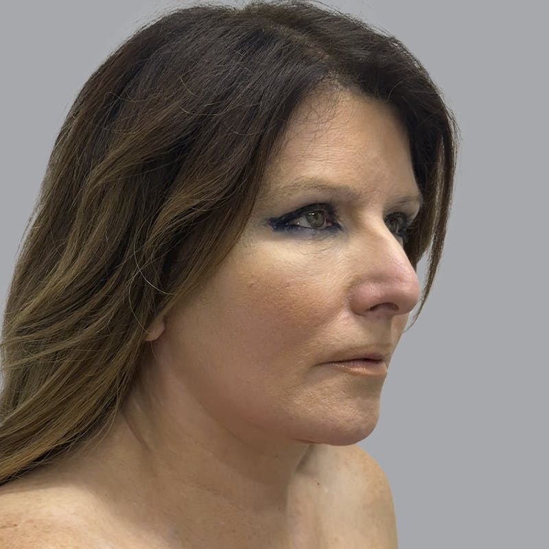 Facelift and Neck Lift Before & After Gallery - Patient 151612 - Image 6