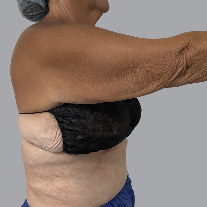 Arm Lift Before & After Gallery - Patient 196908 - Image 7