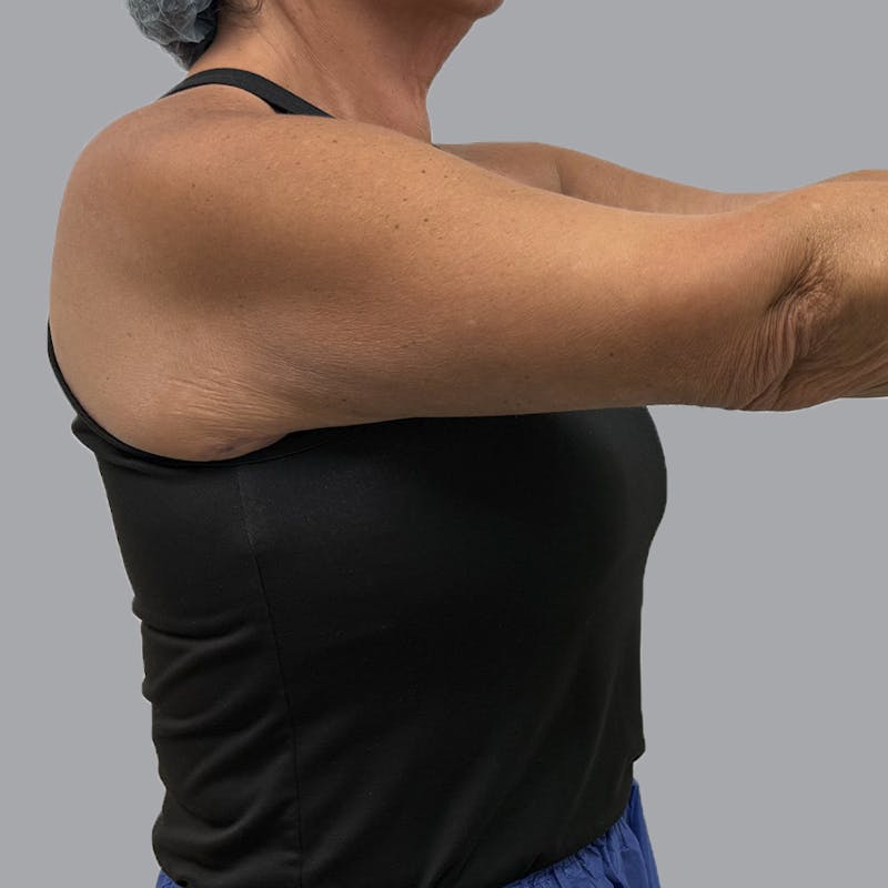 Arm Lift Before & After Gallery - Patient 196908 - Image 8
