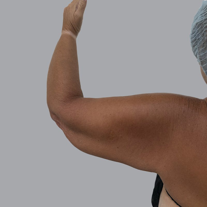 Arm Lift Before & After Gallery - Patient 196908 - Image 3