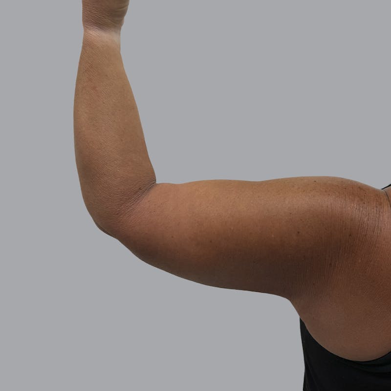 Arm Lift Before & After Gallery - Patient 196908 - Image 4