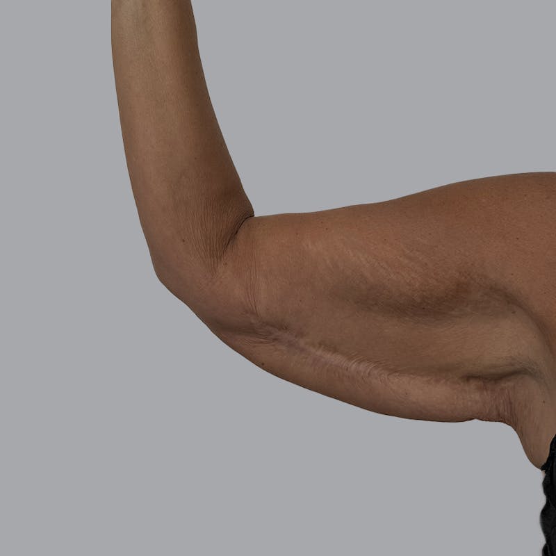 Arm Lift Before & After Gallery - Patient 196908 - Image 5