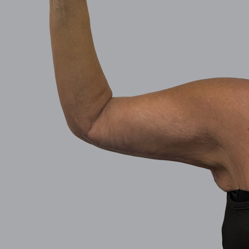 Arm Lift Before & After Gallery - Patient 196908 - Image 6