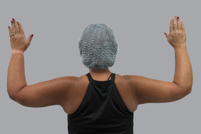 Arm Lift Before & After Gallery - Patient 196908 - Image 2