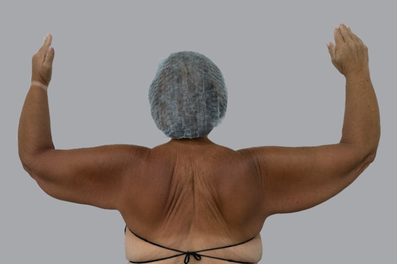 Arm Lift Before & After Gallery - Patient 196908 - Image 1