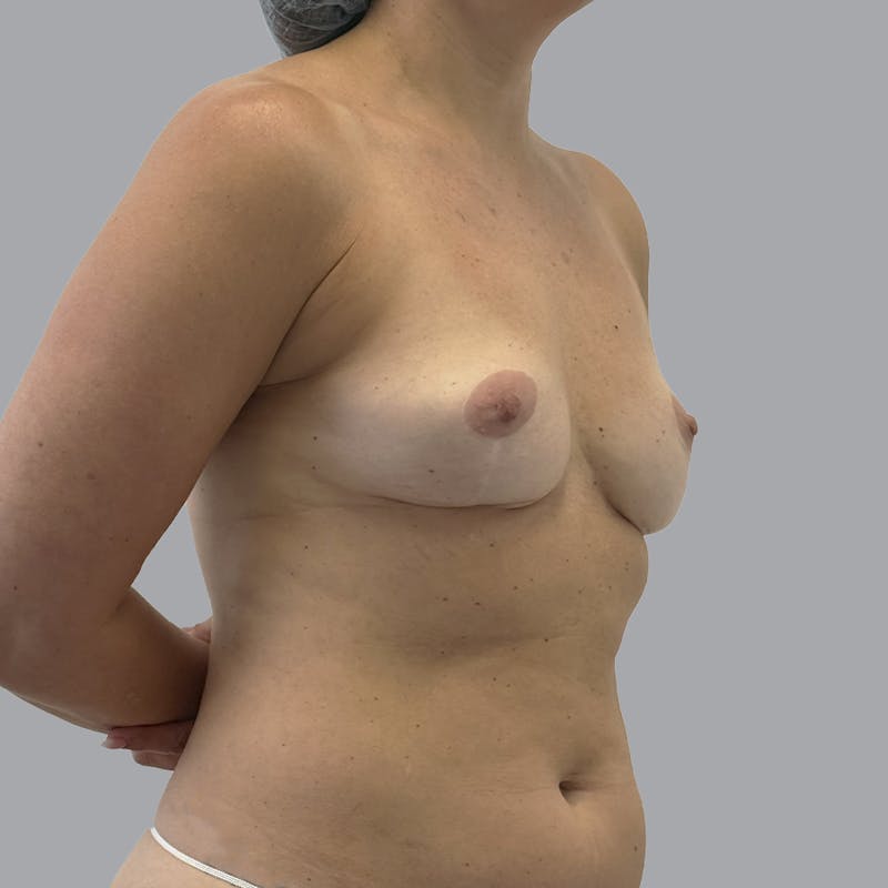 Breast Augmentation with Fat Transfer Before & After Gallery - Patient 825671 - Image 5