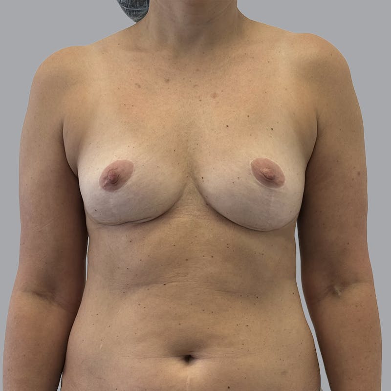 Breast Augmentation with Fat Transfer Before & After Gallery - Patient 825671 - Image 1