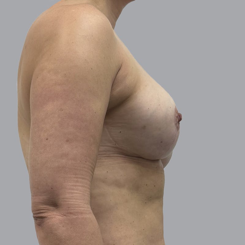 Breast Augmentation with Fat Transfer Before & After Gallery - Patient 825671 - Image 4