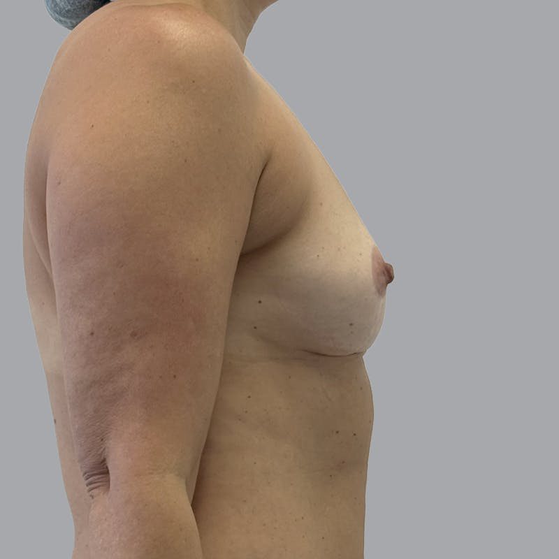Breast Augmentation with Fat Transfer Before & After Gallery - Patient 825671 - Image 3