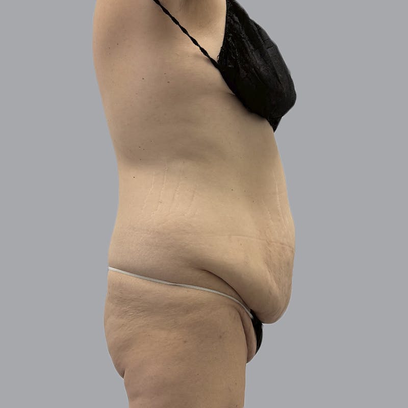 Abdominoplasty Before & After Gallery - Patient 397101 - Image 5
