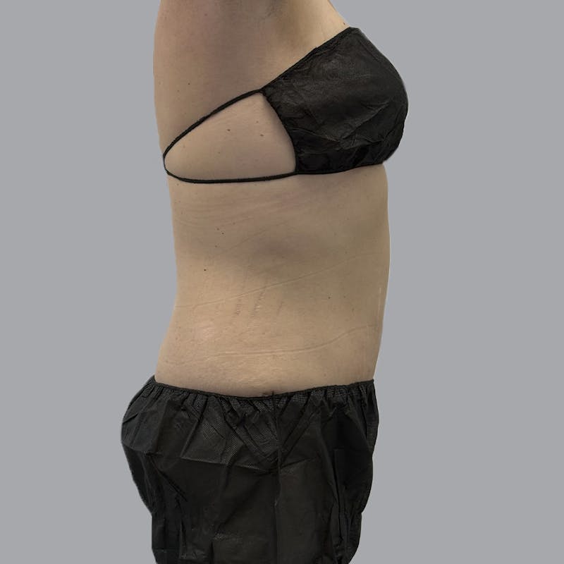 Abdominoplasty Before & After Gallery - Patient 397101 - Image 6