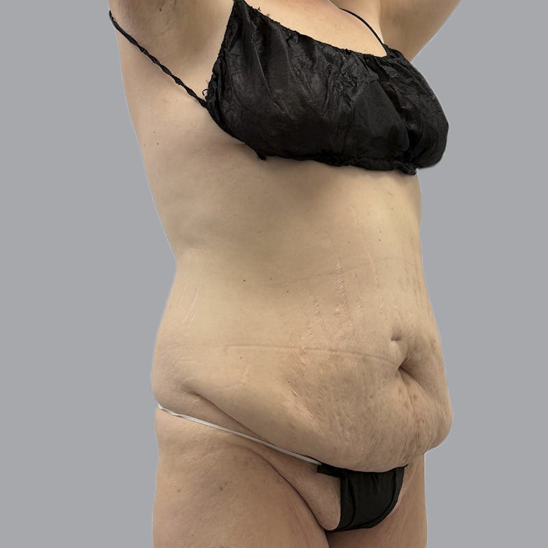Abdominoplasty Before & After Gallery - Patient 397101 - Image 3