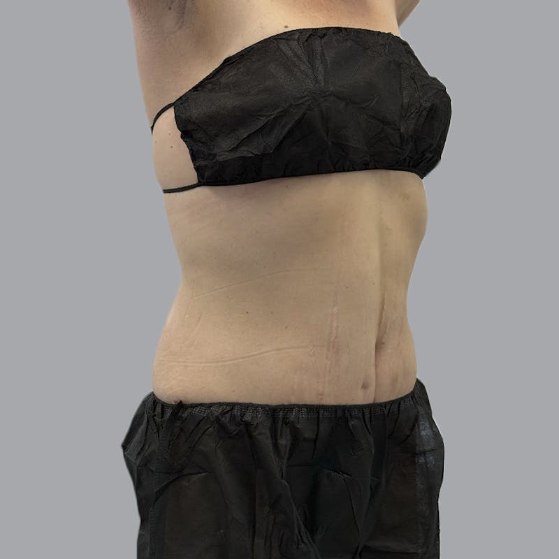Abdominoplasty Before & After Gallery - Patient 397101 - Image 4