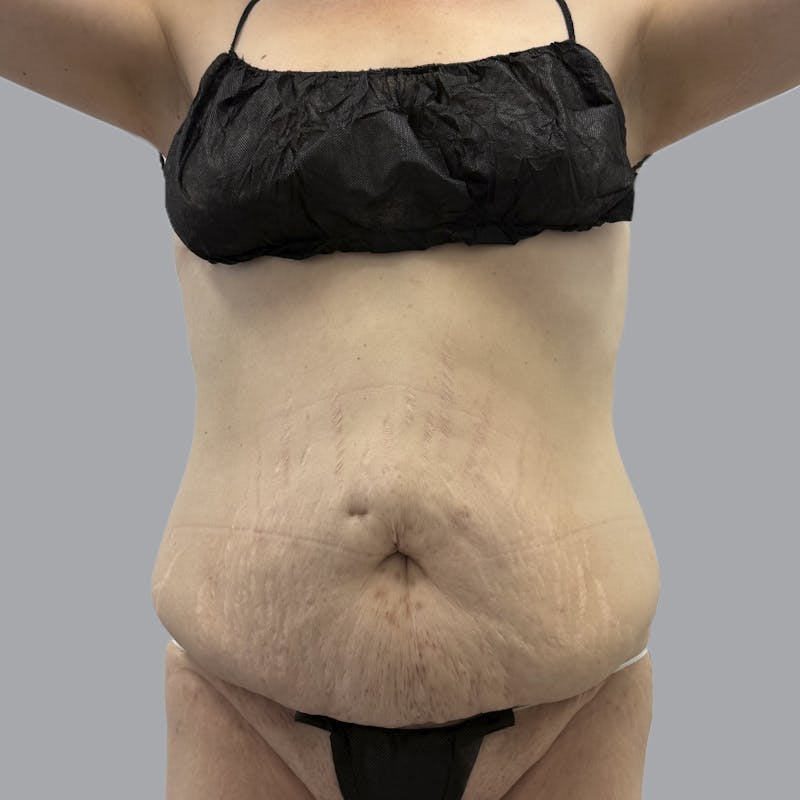 Abdominoplasty Before & After Gallery - Patient 397101 - Image 1