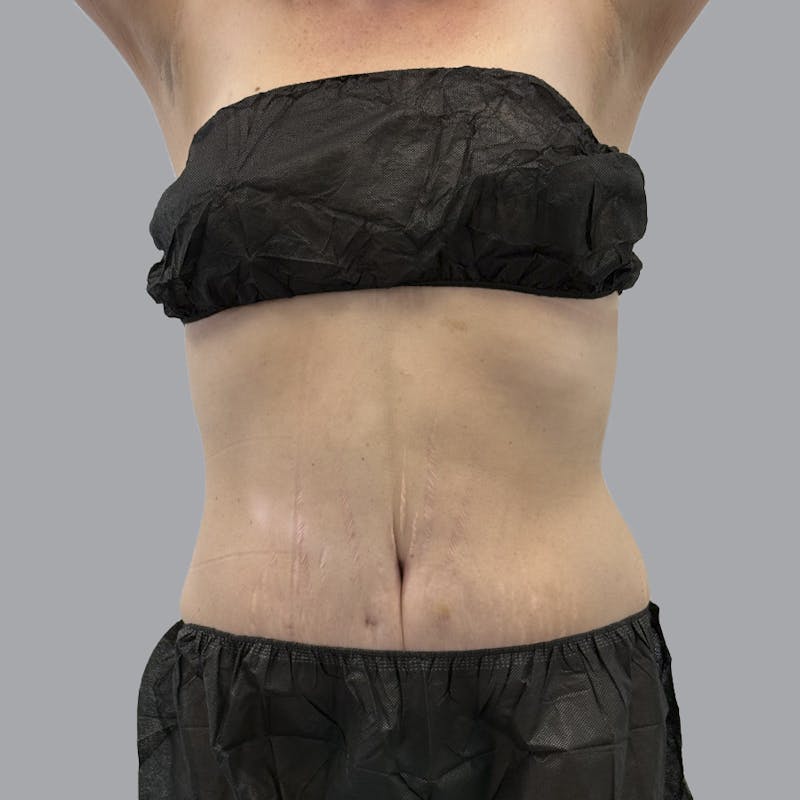 Abdominoplasty Before & After Gallery - Patient 397101 - Image 2