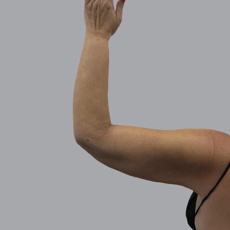 Arm Liposuction Before & After Gallery - Patient 163830 - Image 6