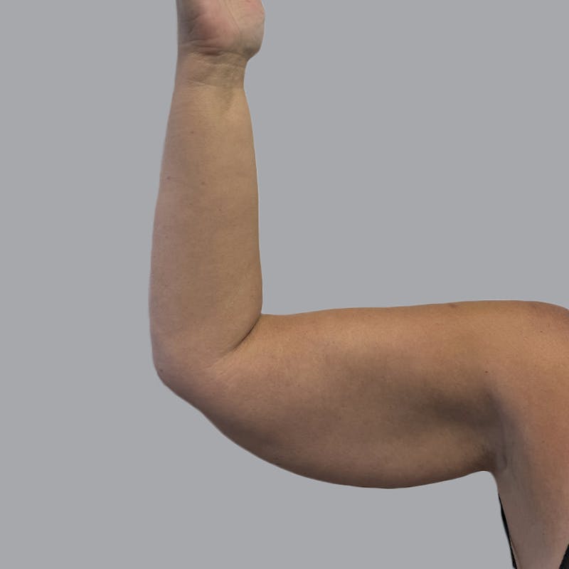 Arm Liposuction Before & After Gallery - Patient 163830 - Image 3