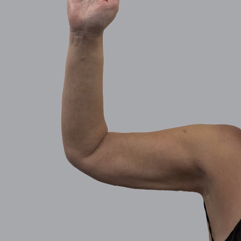 Arm Liposuction Before & After Gallery - Patient 163830 - Image 4