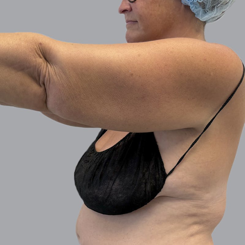 Arm Liposuction Before & After Gallery - Patient 163830 - Image 7