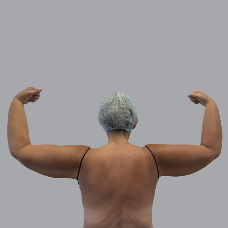 Arm Liposuction Before & After Gallery - Patient 163830 - Image 1