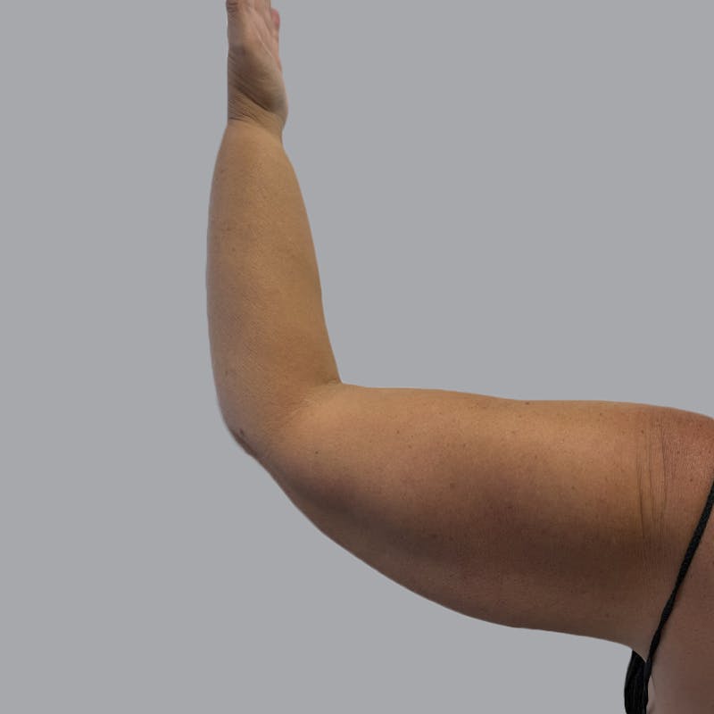 Arm Liposuction Before & After Gallery - Patient 163830 - Image 5