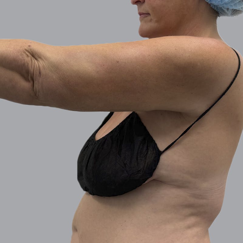 Arm Liposuction Before & After Gallery - Patient 163830 - Image 8