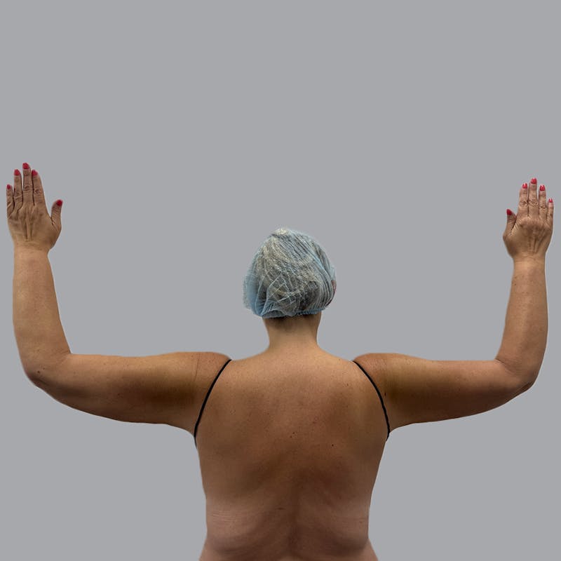 Arm Liposuction Before & After Gallery - Patient 163830 - Image 2