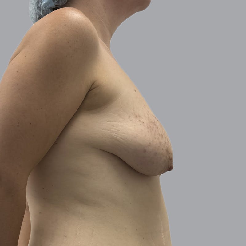 Breast Lift Before & After Gallery - Patient 394078 - Image 5