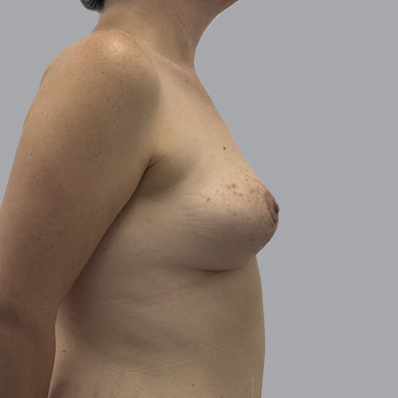 Breast Lift Before & After Gallery - Patient 394078 - Image 6