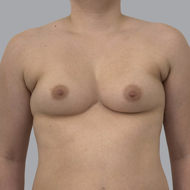 Breast Augmentation with Fat Transfer Before & After Gallery - Patient 280835 - Image 1