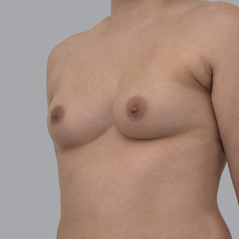 Breast Augmentation with Fat Transfer Before & After Gallery - Patient 280835 - Image 3