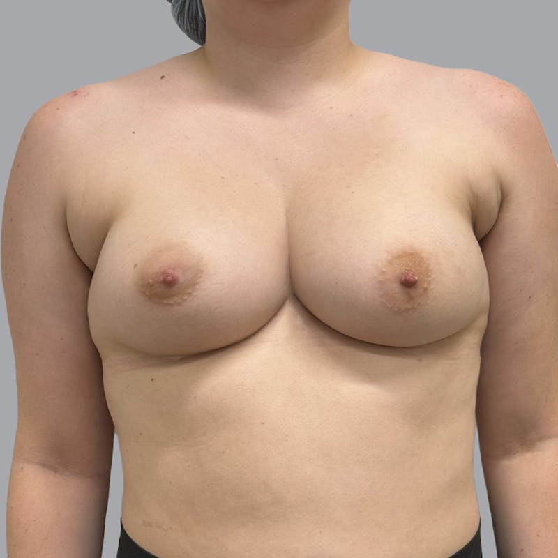 Breast Augmentation with Fat Transfer Before & After Gallery - Patient 280835 - Image 2