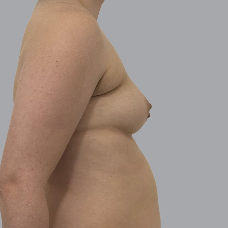 Breast Augmentation with Fat Transfer Before & After Gallery - Patient 280835 - Image 5