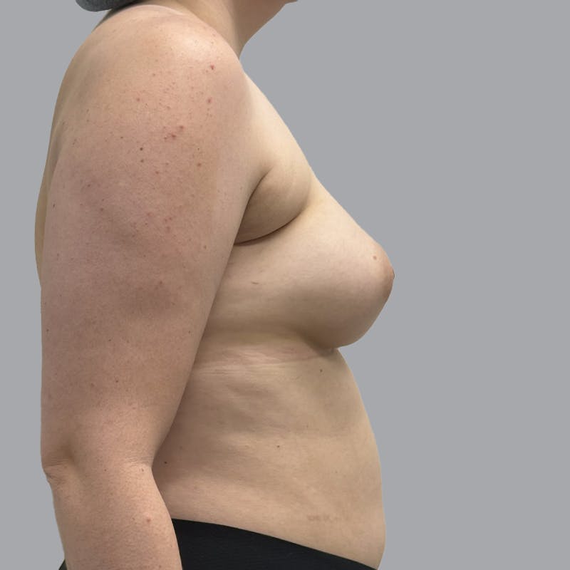 Breast Augmentation with Fat Transfer Before & After Gallery - Patient 280835 - Image 6