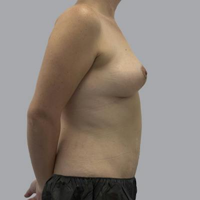 Mommy Makeover Before & After Gallery - Patient 358843 - Image 6