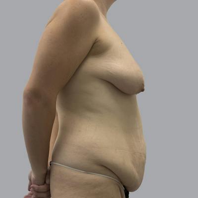 Mommy Makeover Before & After Gallery - Patient 358843 - Image 5