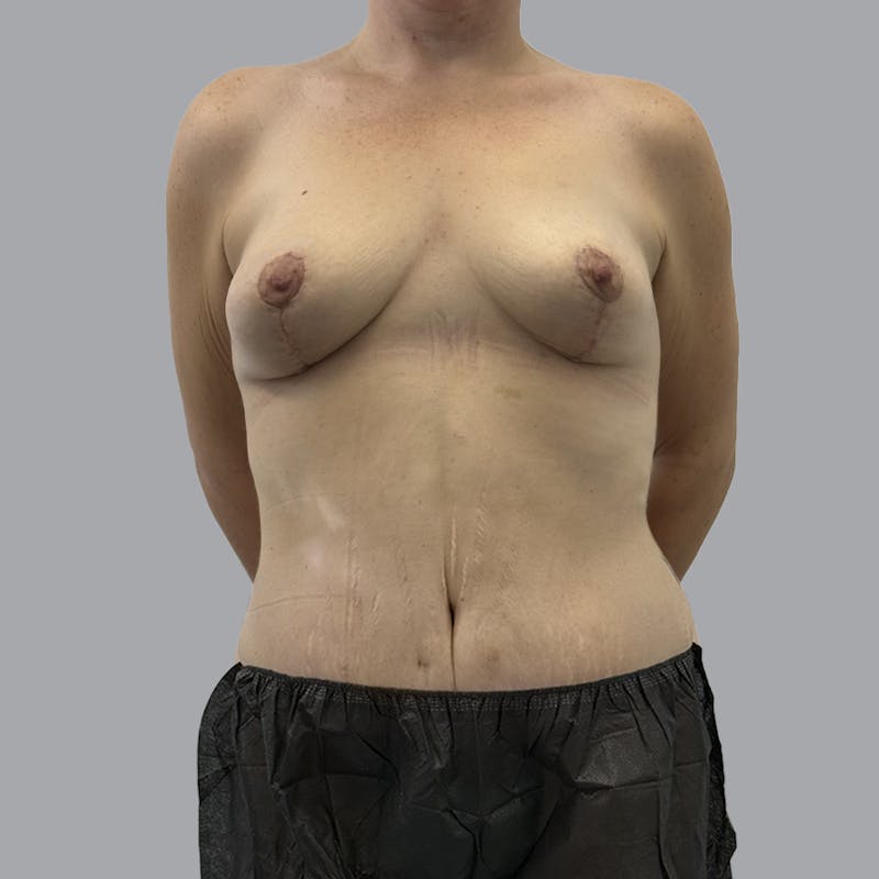 Mommy Makeover Before & After Gallery - Patient 358843 - Image 2