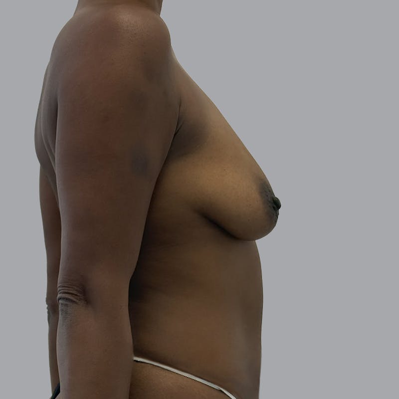 Breast Augmentation with Fat Transfer Before & After Gallery - Patient 186139 - Image 5