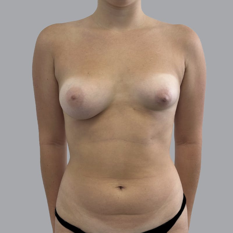 Breast Augmentation with Fat Transfer Before & After Gallery - Patient 384788 - Image 1
